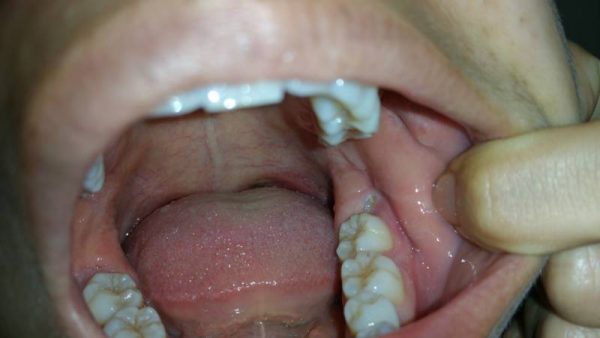 Chẳng may nhổ chân răng khi sót bạn cần nên đến thăm khám tại các cơ sở chuyên khoa để các bác sĩ theo dõi và điều trị