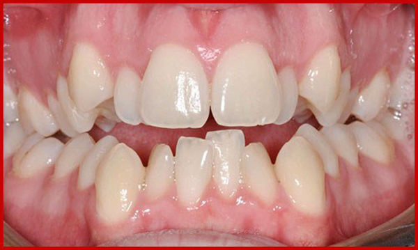 Răng lòi xỉ sẽ gây ra nhiều ảnh hưởng đến sức khỏe, tăng nguy cơ mắc các bệnh lý về răng miệng.