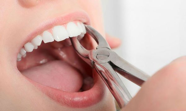 Loại bỏ răng là phương pháp không được ưu tiên tuy nhiên nó vẫn cần được áp dụng để đảm bảo an toàn cho những chiếc răng khỏe còn lại.