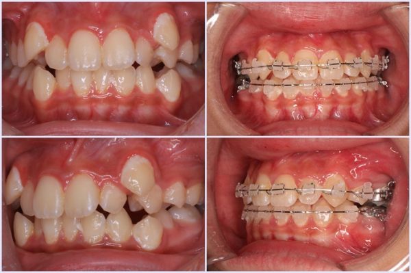 Niềng răng là phương pháp điều chỉnh răng lòi xỉ an toàn và tiết kiệm chi phí tuy nhiên có nhược điểm là mất nhiều thời gian để cải thiện.