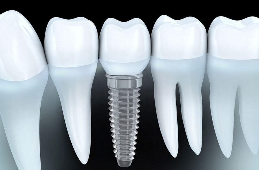 Cần phải tìm hiểu và hỏi kỹ về loại răng Implant sẽ được cấy ghép