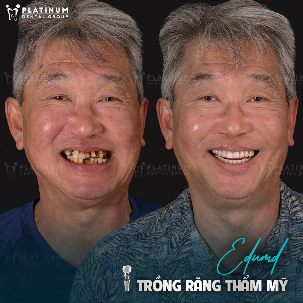 Befor - After trồng răng implant tại Platinum Dental