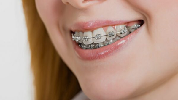 Niềng răng hô nhẹ là như thế nào