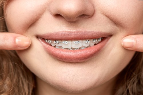 Phương pháp niềng răng hô nhẹ bằng mắc cài