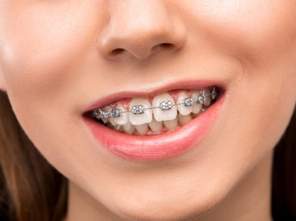 Niềng răng hô nhẹ tốn bao nhiêu thời gian ?