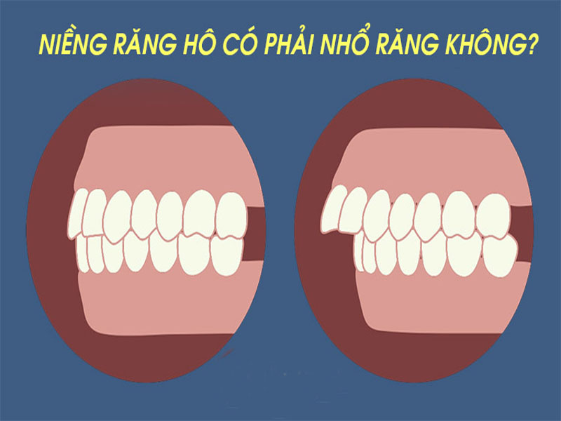 Niềng răng hô nhẹ có phải nhổ răng hay không