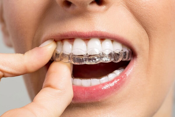 Niềng răng Invisalign có tốt như bạn nghĩ? Niềng răng Invisalign có tốt như bạn nghĩ?