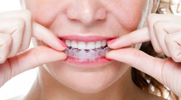Thời gian niềng răng Invisalign mất bao lâu?