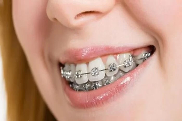 Niềng răng hô thật sự có tốt hay không?
