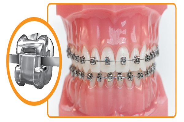 Niềng răng hô bằng mắc cài tự đóng/ tự khóa