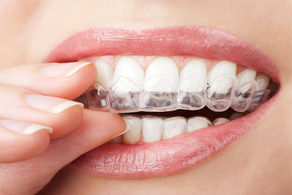Niềng răng hô trong suốt không sử dụng mắc cài
