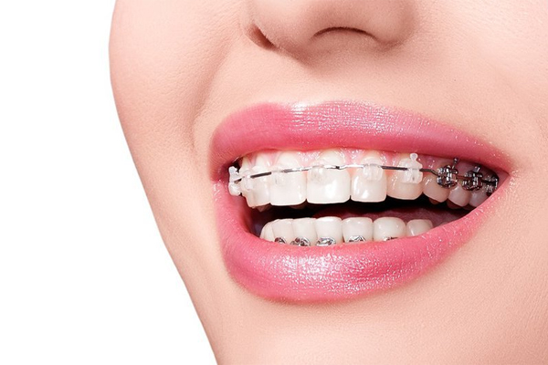 Mất bao lâu để phương pháp niềng răng hô hoàn thiện?