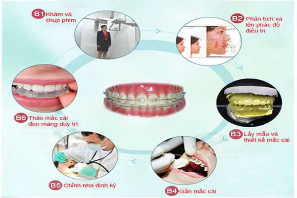 Quy trình niềng răng hô tại Nha Khoa Platinum