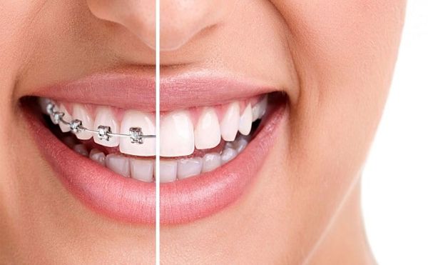 Khi niềng răng hô cần lưu ý đến các yếu tố nào ?