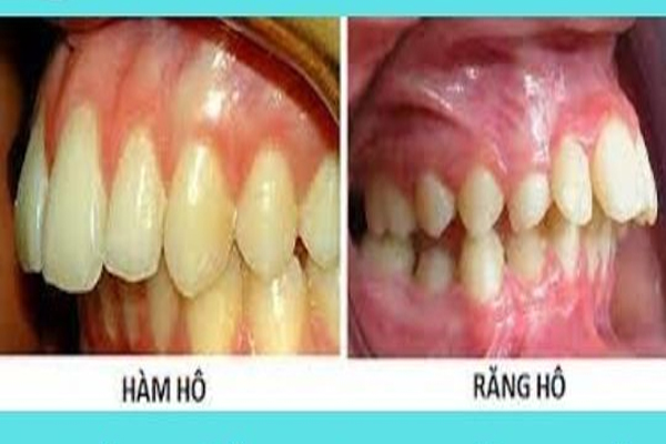 3 cách giúp nhận biết bạn có đang bị hô hay không