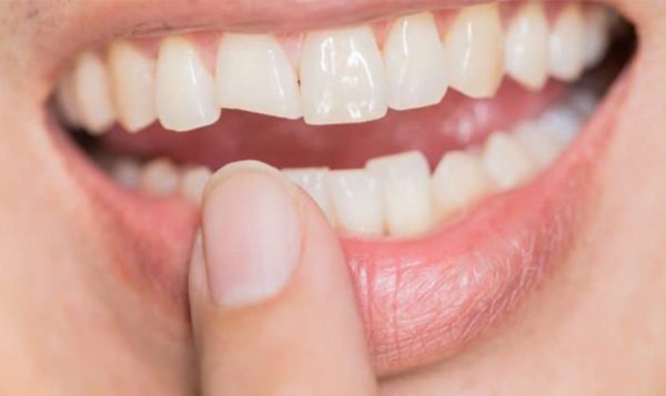 Mặt dán sứ mẻ, bị vỡ phải làm sao để khắc phục?
