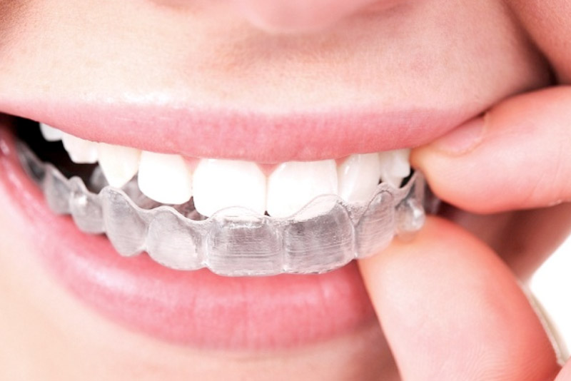 Niềng răng trong suốt có đau không, cảm giác đau có khó chịu? Niềng răng trong suốt có đau không, cảm giác đau có khó chịu?