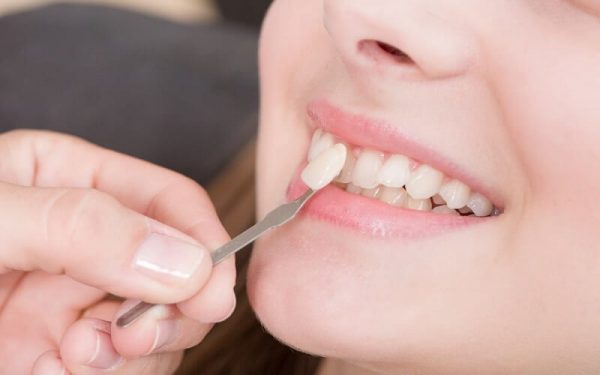 Dán sứ Veneer rất bền, có đến 20 năm mới có thể bị bong ra nếu dán đúng kỹ thuật
