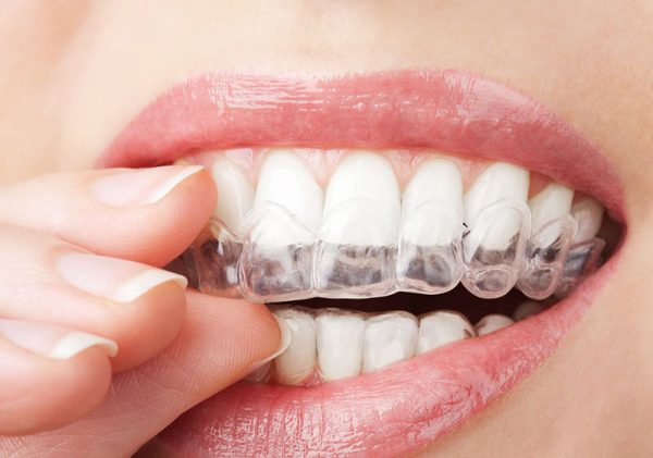Niềng răng Invisalign Niềng răng Invisalign