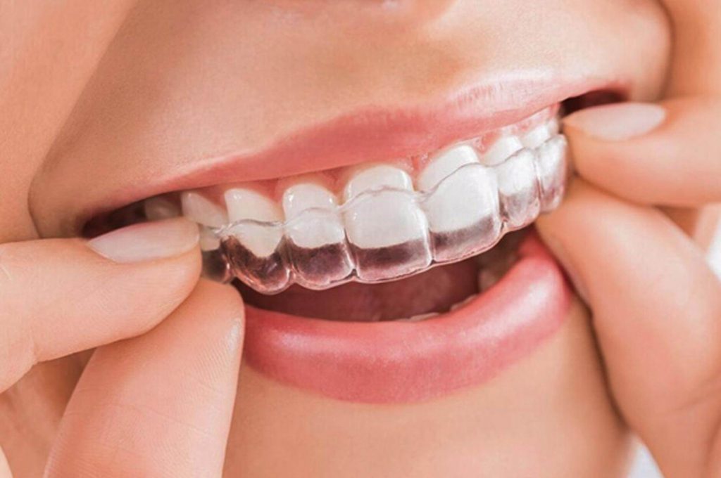 quy-trinh-nieng-rang-invisalign-1