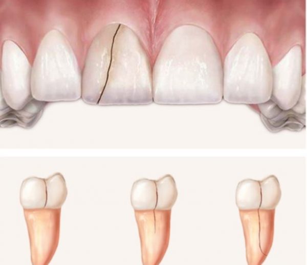 Cách xử lý răng sứ bị nứt thế nào?