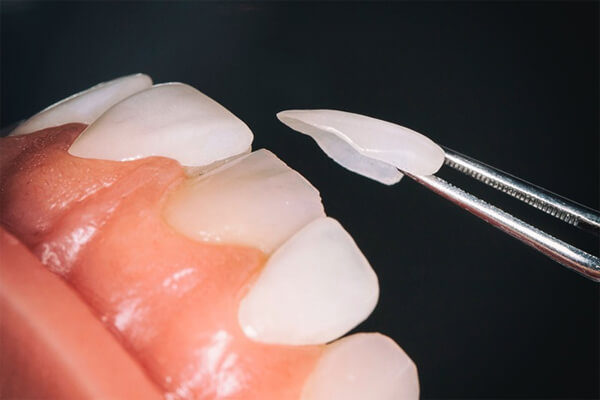 Có trường hợp dán sứ Veneer rớt hay không?