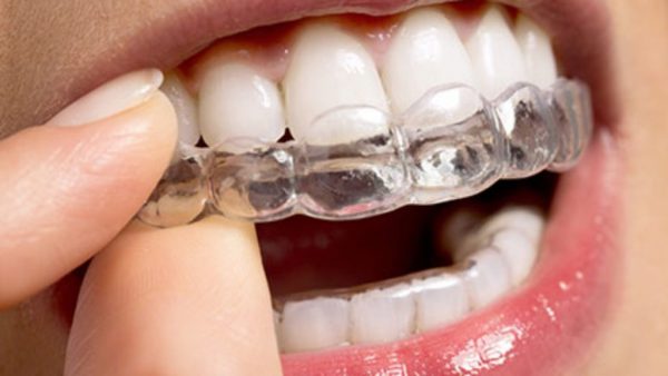 Niềng răng trong suốt cần tránh hút thuốc