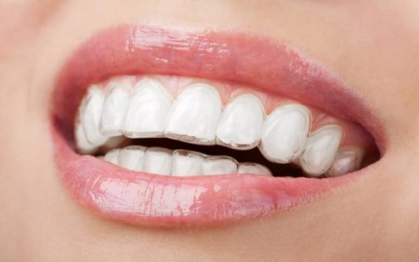 Niềng răng trong suốt bao lâu phụ thuộc độ tuổi