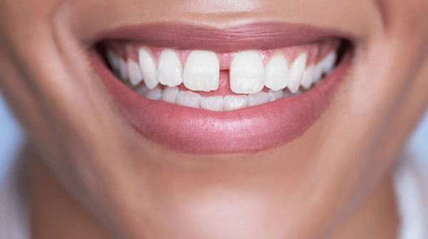 Nhổ răng trước khi niềng giúp sắp xếp các răng đúng cách Nhổ răng trước khi niềng giúp sắp xếp các răng đúng cách