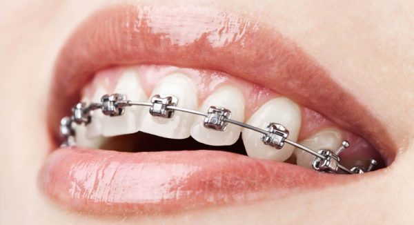Niềng răng thưa mất bao nhiêu thời gian?