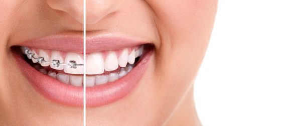 Niềng răng thưa mất bao lâu?