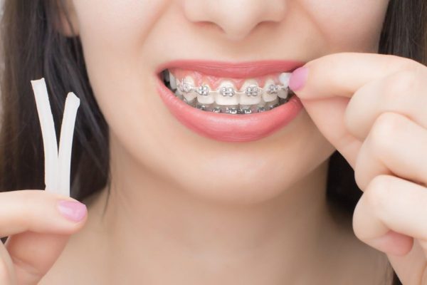 Chi phí khi niềng răng phụ thuộc vào khá nhiều yếu tố