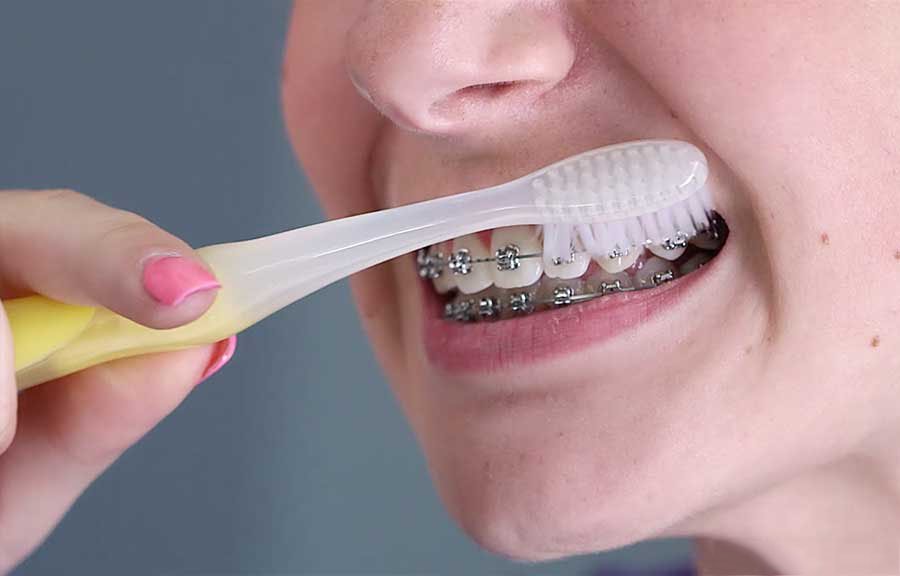 Phương pháp niềng răng trong suốt cho cảm giác hôn thoải mái, dễ chịu hơn Phương pháp niềng răng trong suốt cho cảm giác hôn thoải mái, dễ chịu hơn