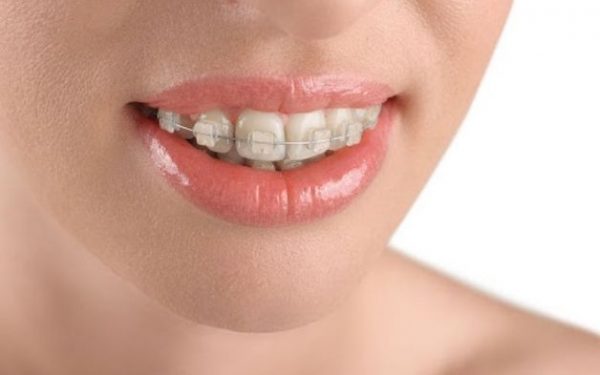 Có rất nhiều nguyên nhân khiến việc niềng răng xong vẫn xấu