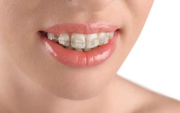 Có rất nhiều nguyên nhân khiến việc niềng răng xong vẫn xấu