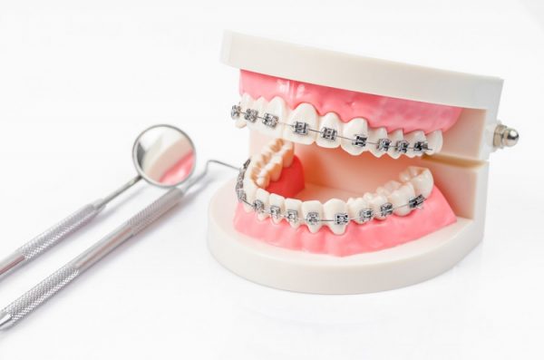 Đeo hàm duy trì sau khi tháo khí cụ niềng là điều cần thiết để cố định răng ở đúng vị trí Đeo hàm duy trì sau khi tháo khí cụ niềng là điều cần thiết để cố định răng ở đúng vị trí