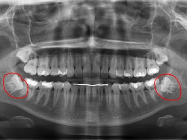 Răng khôn gây ra nhiều phiền toái, khó chịu cho người bệnh nếu nó không mọc theo hướng thông thường Răng khôn gây ra nhiều phiền toái, khó chịu cho người bệnh nếu nó không mọc theo hướng thông thường