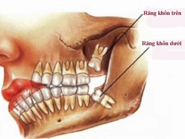 Răng khôn mọc lệch, mọc ngang còn với thể gây tiêu chân răng của răng kế bên