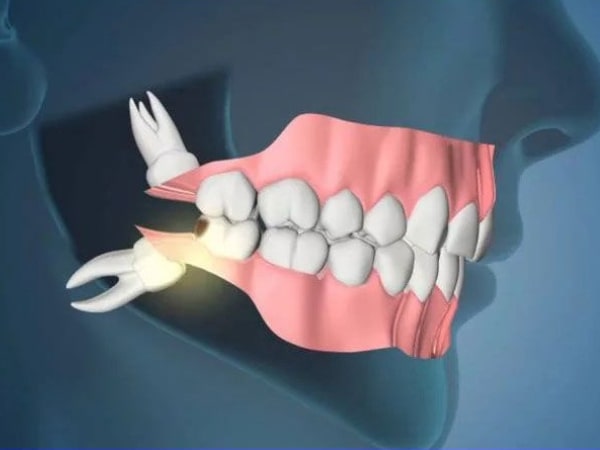 Răng khôn có thể gây ra hội chứng giao cảm như đau một bên mặt, phù mặt Trường hợp nào nên nhổ răng khôn hàm trên? - Rối loạn phản xạ và cảm giác