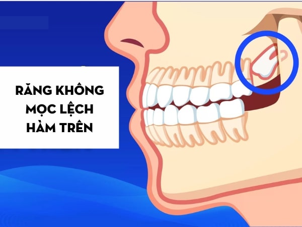 Tùy vào vị trí mọc răng khôn mà quyết định xem có nhổ hay không? Nhổ răng khôn hàm trên có hiểm nguy không?