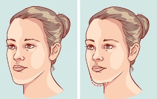 Niềng răng thay đổi góc nghiêng thật không