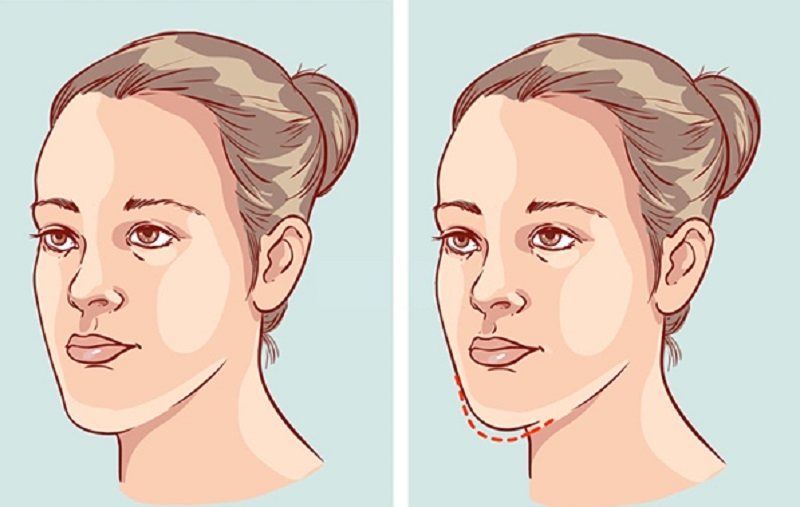 Niềng răng thay đổi góc nghiêng thật không