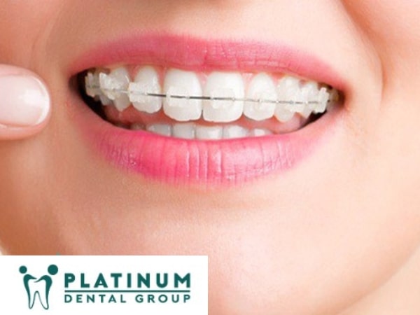 Không phải trường hợp nào niềng răng xong cũng bị tam giác nướu Khe hở tam giác nướu là gì?