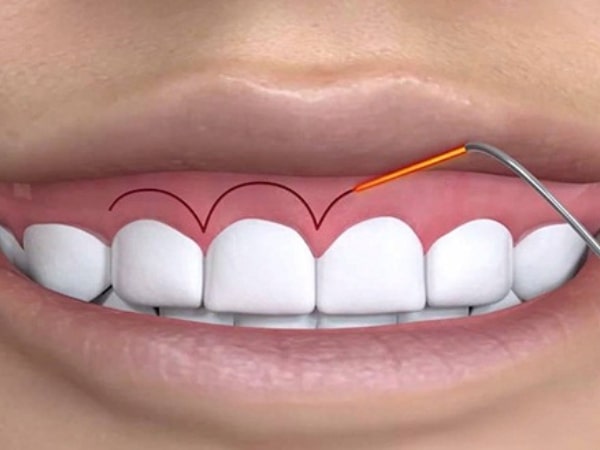 Nguyên nhân khe hở tam giác nướu sau niềng