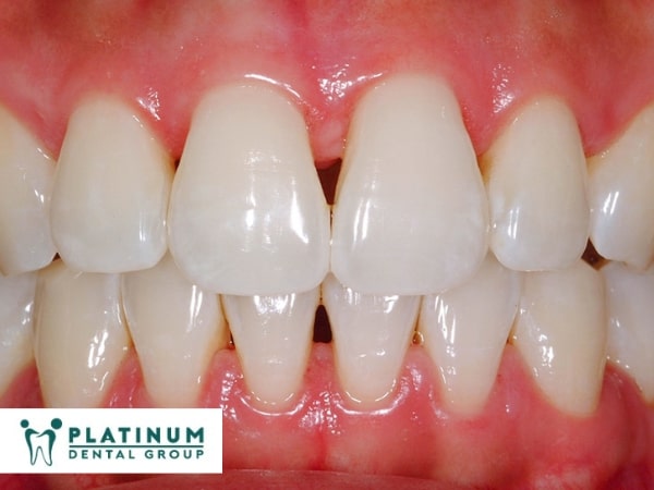 Tam giác nướu tích trữ thành mảng bám, sâu răng ảnh hưởng đến sức khỏe răng miệng Hậu quả ví như kéo dài hiện trạng tam giác nướu ở răng