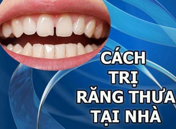 Điều trị răng thưa tại nhà như thế nào để đạt hiệu quả
