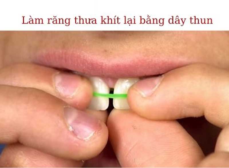 Điều trị răng thưa tại nhà bằng dây thun