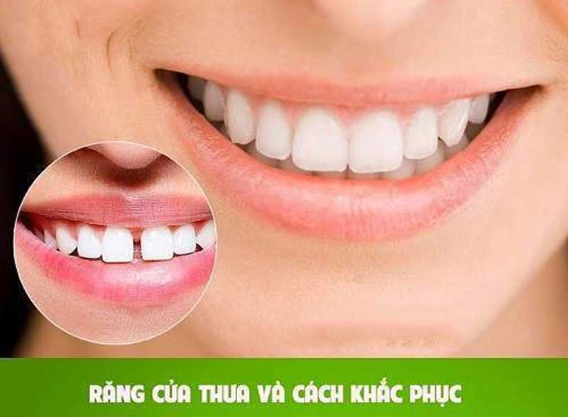 Răng cửa thưa nên làm gì để lấy lại nụ cười tự tin ?