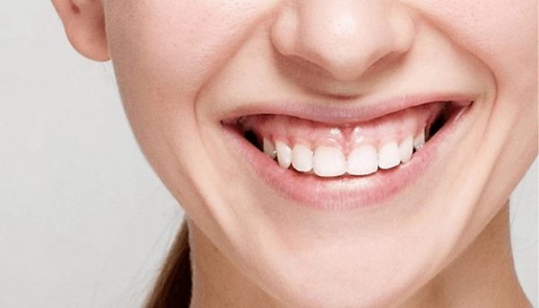 Nụ cười hở nướu