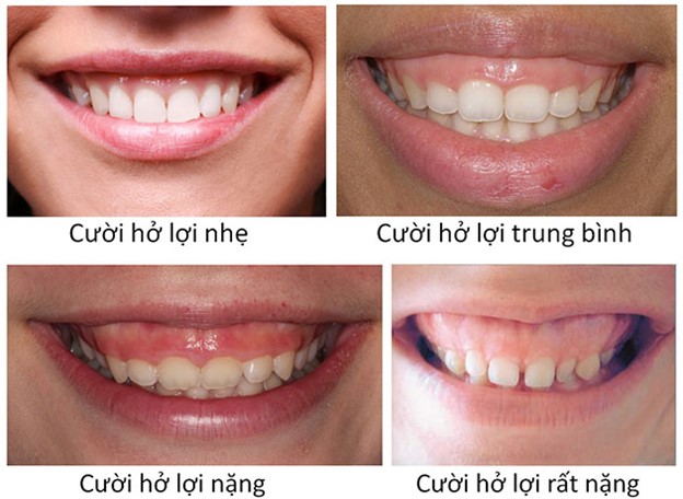 Nụ cười hở nướu